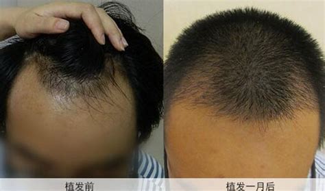 郑州科发源植发怎么样 男士种植头发5个月后成功摆脱秃顶_郑州大麦微针植发植发案例 - 毛毛网