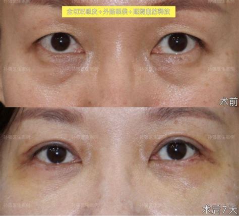 北京眼综合分享：双眼皮+祛眼袋是什么样的效果 - 知乎