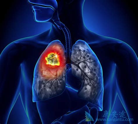癌细胞转移到全身肺癌晚期有什么症状-康安途海外医疗