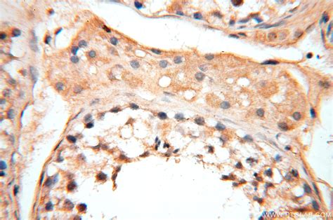 加权基因共表达网络分析在鉴定卵巢癌干细胞特性关键基因的应用