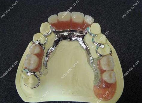 纯钛活动假牙价格:纯钛全口活动义齿6000元+/半口假牙3000元起 - 口腔资讯 - 牙齿矫正网