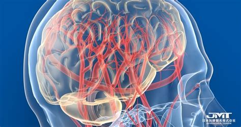 先天性血管异常的脑动静脉畸形，年轻人也有可能引发脑出血