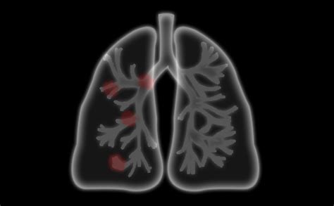 肺癌早期有这4种表现，40岁以上朋友要重视，拖到晚期后悔也没用_患者_肿瘤_水果