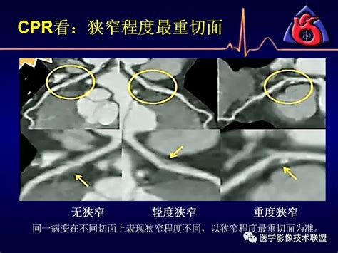 湘雅医院冠脉CTA标准化图像后处理及规范化诊断报告书写-搜狐大视野-搜狐新闻