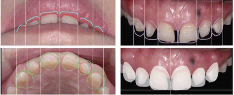 前牙美学分析与设计之三-上中切牙龈缘的确定 - 美学与功能 - 齿美科技 - 专注牙齿美学修复，打造高品质在线口腔教育平台 ...