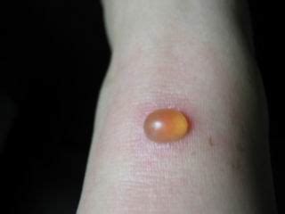 虫咬皮炎是夏秋季节常见的儿童皮肤图片_有来医生