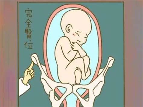 胎儿臀位的姿势图是什么样子的?_家庭医生在线