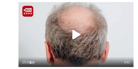 英学者称秃顶男性感染新冠后 发展成重症的风险更高(含视频)_手机新浪网