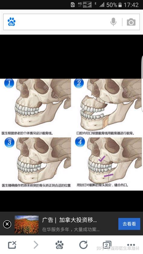正颌手术的lefort1的上颌前推和顺旋有什么区别？ - 知乎