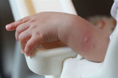婴儿蚊虫叮咬红肿用什么药（宝宝经常被蚊子叮咬的皮肤红肿）-幼儿百科-魔术铺