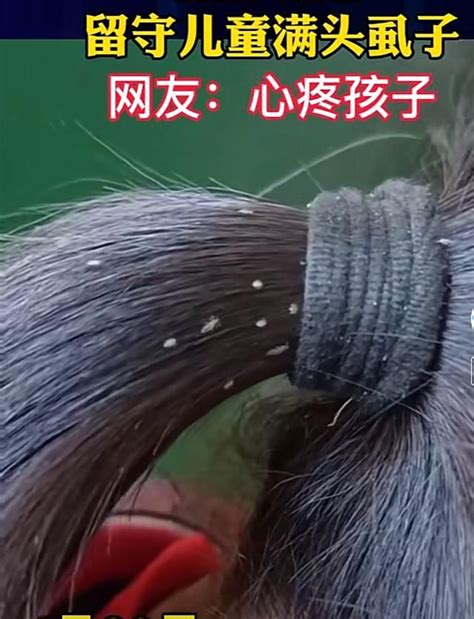 小白点头虱卵图片