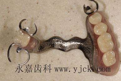纯钛支架：一种理想的活动义齿修复方式-严明的博客-KQ88口腔博客