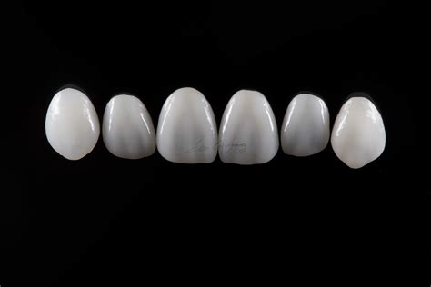 美加瓷贴面案例丨修复前牙磨损、牙齿美白-美加的博客-KQ88口腔博客