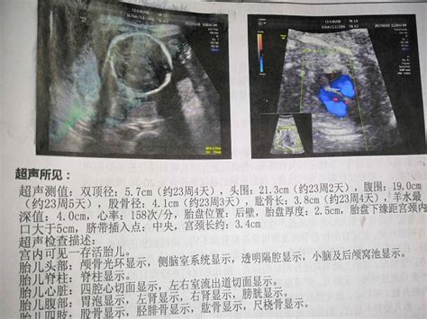 关于胎儿心脏彩超的几个问题（单脐动脉） - 百度宝宝知道