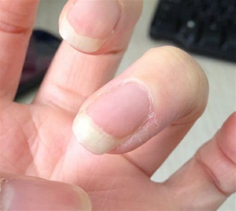 左手大拇指指甲有一条淡褐色竖线，好几年了，微量元素也正常，为什么啊？ - 知乎