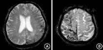 脑淀粉样血管病（CAA）最新诊断标准 Boston2.0 - 脑医汇 - 神外资讯 - 神介资讯
