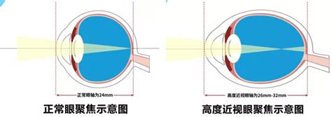 右眼近视150左眼近视25严重吗