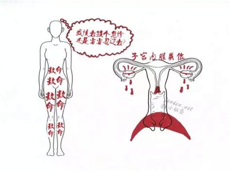 子宫内膜异位症月经过后肛门也坠痛