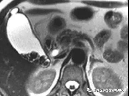 胆囊炎的克星山楂