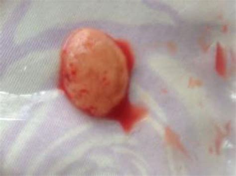 药流后25天hcg正常吗