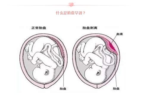 胎盘厚会导致胎盘早剥吗