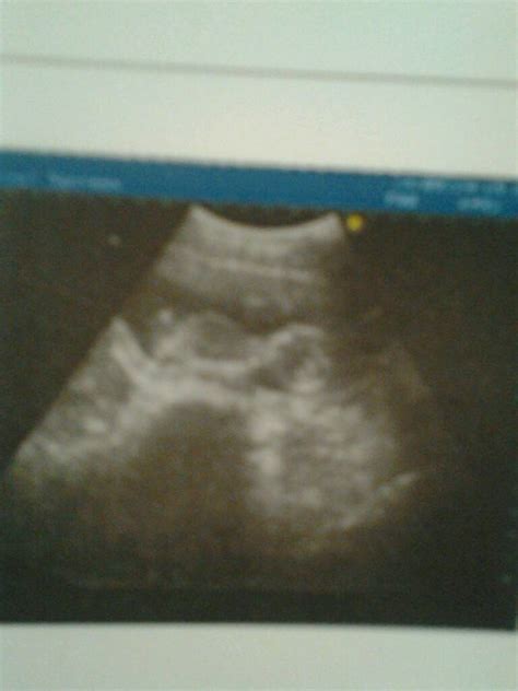 怀孕3个月胎儿b超图片