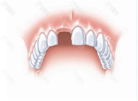 口腔牙齿问题多对孕期有影响吗
