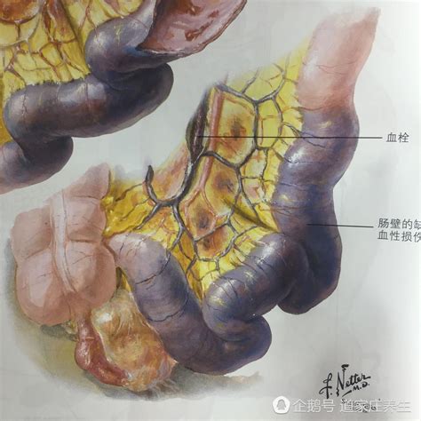 痔疮肉球能不能用手捏爆
