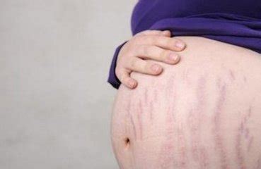 产后如何预防消除妊娠纹