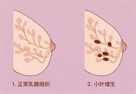 查出乳腺小叶增生会癌变吗