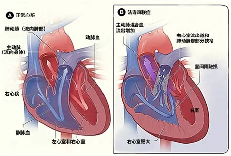 复杂性先心病是怎么回事