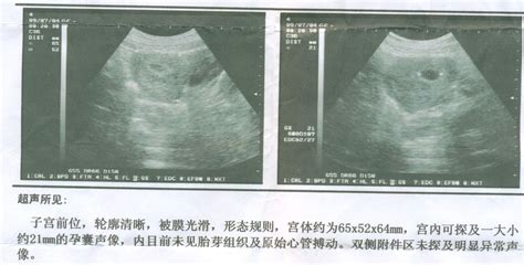八周大的胎儿b超图片