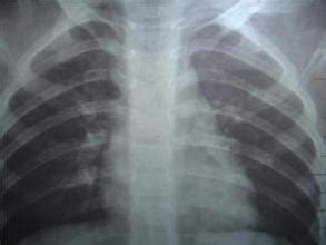 11岁儿童新冠肺炎早期的5个信号