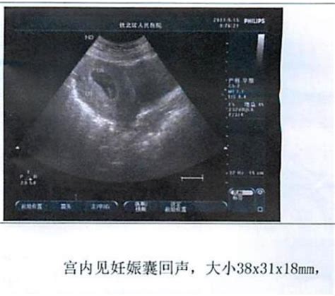 怀孕45天孕囊很小是怎么回事