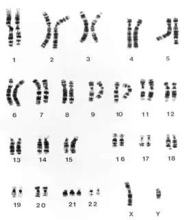 染色体异常婚检能查出来吗