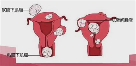 子宫会移位有什么症状