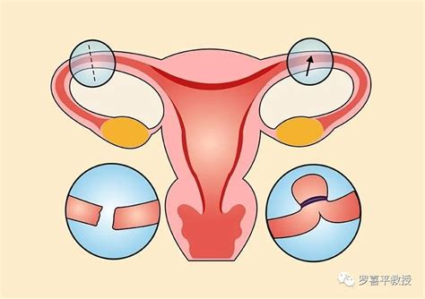 双子宫能顺产生孩子吗
