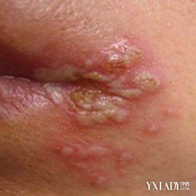 小孩嘴唇干裂起泡怎么办