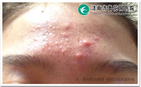 长了青春痘怎么办
