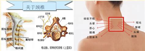 颈椎病吃颈复康还管用吗