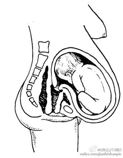 胎位不正是不是只能剖腹产了