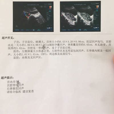 低回声边界欠清未见血流信号
