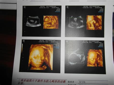 35周胎儿偏小3周