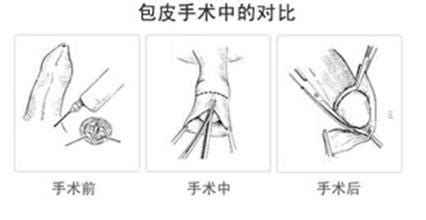 性生活后马上排尿能避孕吗