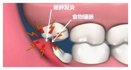 最后一颗磨牙拔掉后不补可以吗