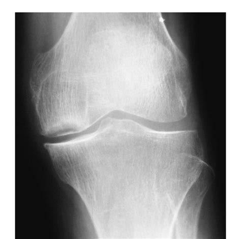 胸下左边隐痛怎么回事