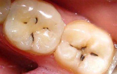 8个原因易让牙齿染色,喝茶牙齿染色多久能白