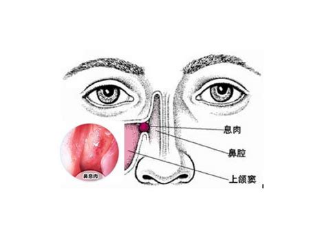 粘脓鼻涕就是鼻窦炎吗