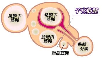 宫外孕的早期征兆怎么治疗