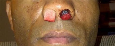 怀孕出鼻血是什么原因